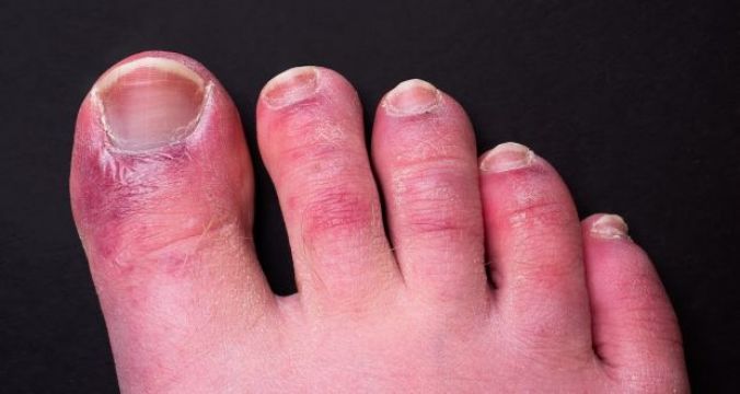‘Covid Toes’ Could Be Side Effect Of Immune System’s Response To Virus – Study