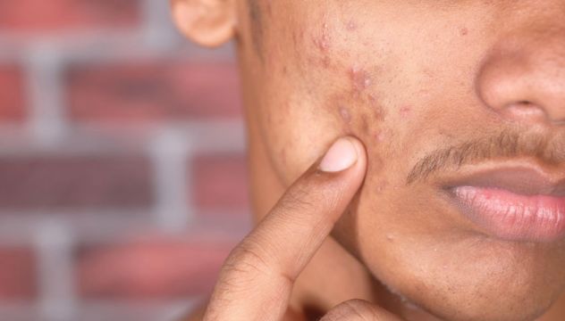 Five Common Acne Myths Debunked By A Dermatologist
