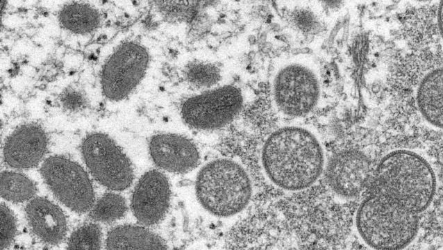 Monkeypox Case Identified In Northern Ireland