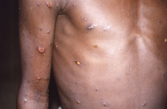 Monkeypox Outbreak ‘May Have Been Sparked By Sex At Raves’