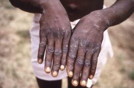 Monkeypox Spread Already An Emergency, Say African Officials
