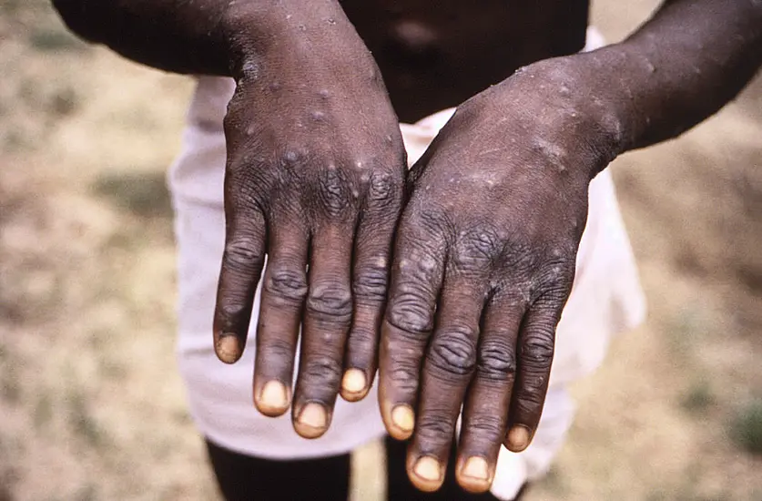 Un Health Agency Declares Monkeypox A Global Emergency