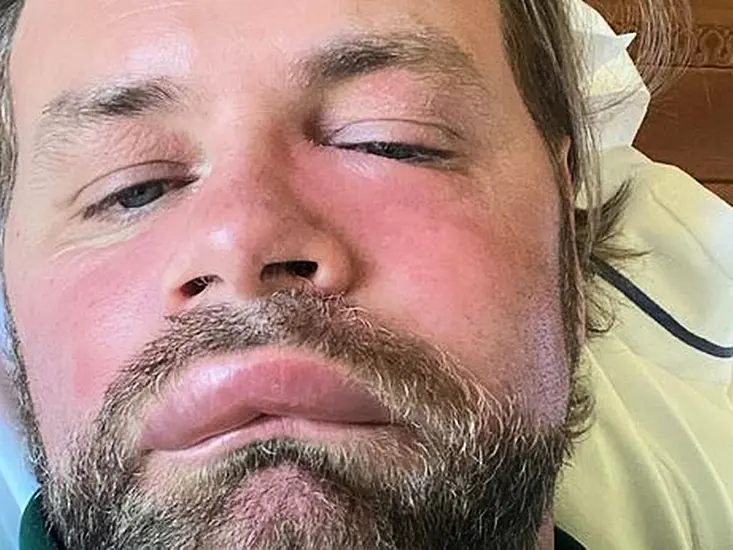 Brian Mcfadden Suffers Severe Allergic Reaction To Bee Sting