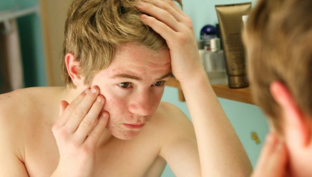 How To Support A Teenager Who Has Acne