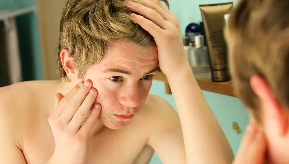 How To Support A Teenager Who Has Acne