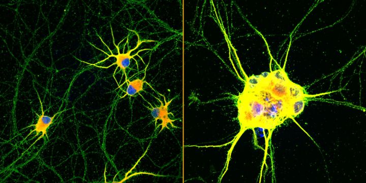 Lab Grown Nerve Cells ‘Holds Promise For Neurodegenerative Disease’