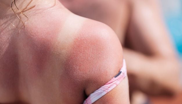 6 Sunburn Myths That Could Put You At Risk