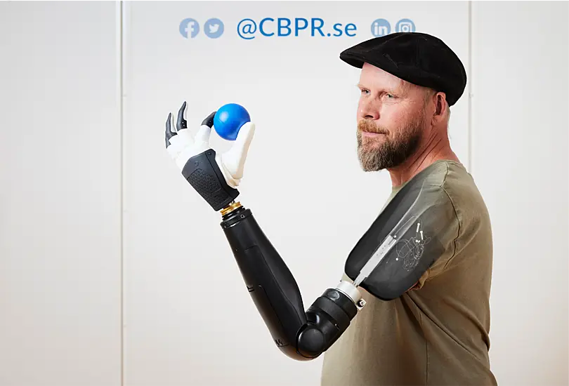 Above-The-Elbow Amputee 'Moves Individual Fingers In Bionic Limb In World First'