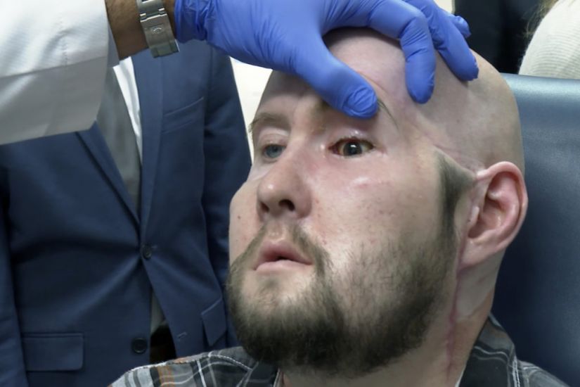 Surgeons Perform World’s First Eye Transplant On Man Who Suffered Electric Shock