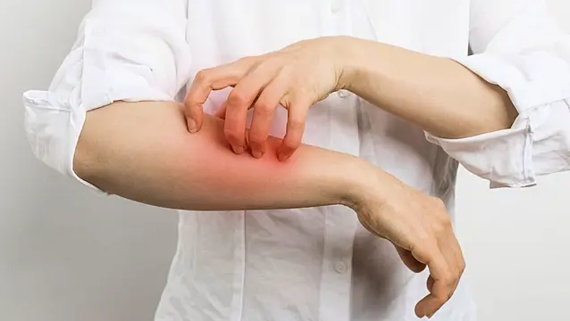 What Is Scabies And How Do You Get It?