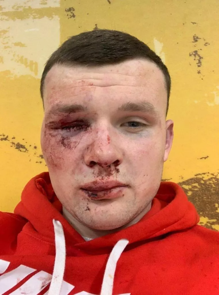 A photograph of Cillian McCarthy taken a short time after he was allegedly targeted by legendary All Ireland hurler Kyle Hayes inside and outside the Icon nightclub in 2019. Photo: Brendan Gleeson