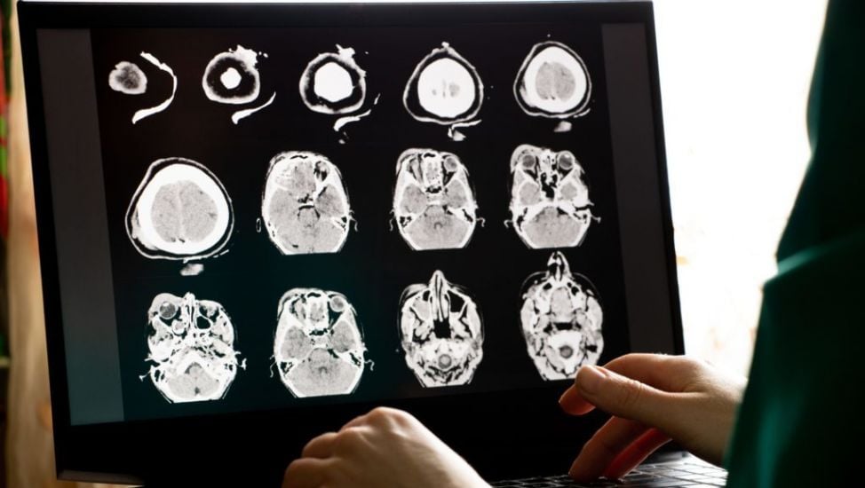 Longer Term Impact Of Sport-Related Brain Injuries Revealed By Study