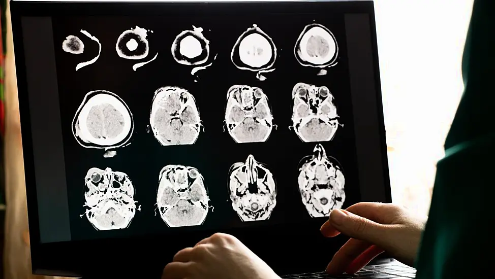 Longer Term Impact Of Sport-Related Brain Injuries Revealed By Study