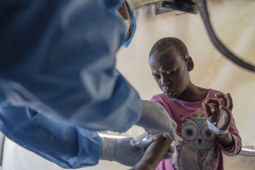 Mpox Outbreaks In Africa Could Be Halted Within Six Months, Says Health Chief