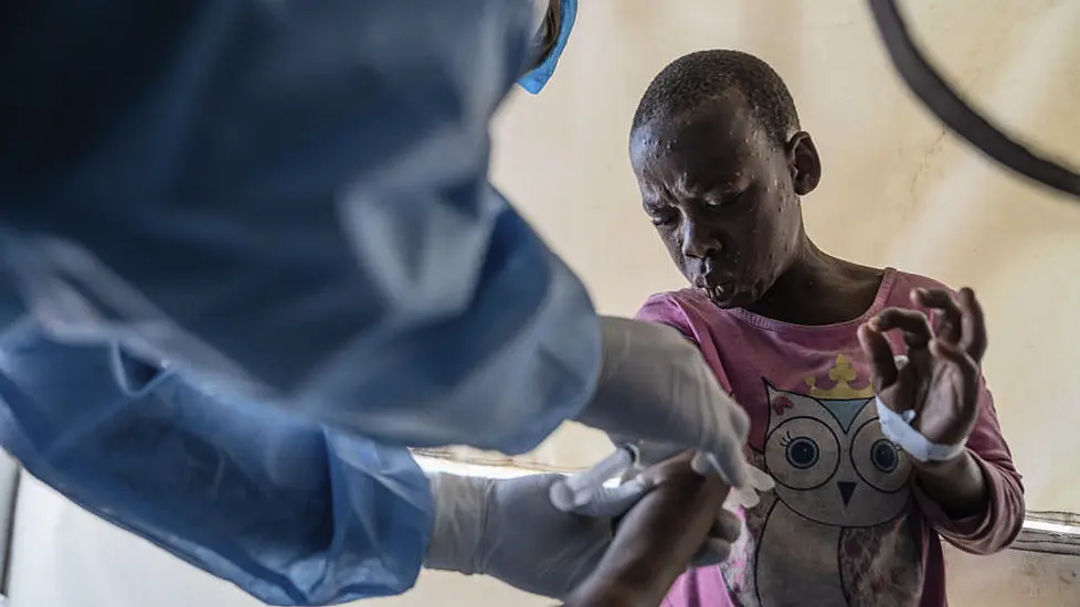 Who Grants First Mpox Vaccine Approval To Ramp Up Response To Disease In Africa