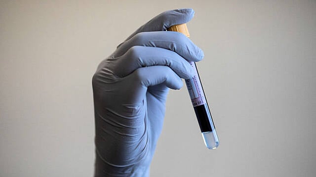 Blood Test Shows Promising Results In Detecting Cancer Early, Study Says