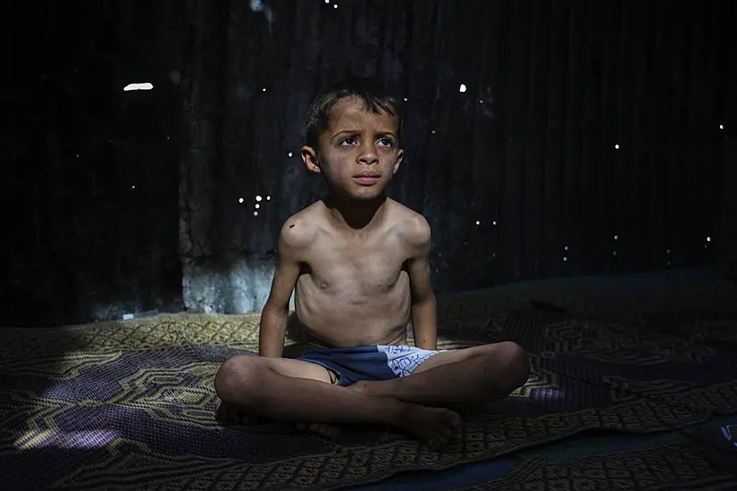 In Pictures: Many In Gaza Face Malnutrition As Blockade Enters Third Month