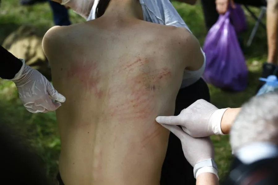 A man shows marks on his body he says were left after a police beating (Sergei Grits/AP)