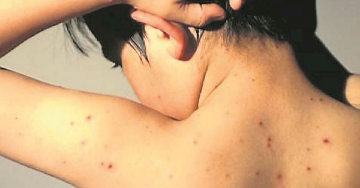 126% increase in hospitalisations from chickenpox | BreakingNews.ie