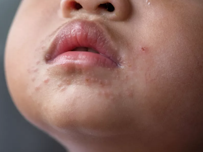 Hand, foot and mouth disease: what you need to know