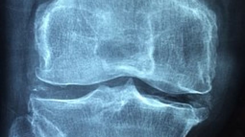 Galway led study reveals increase in patients with fractures from osteoporosis