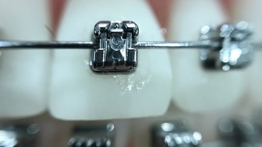 New orthodontists to help tackle lengthy waiting lists across Galway