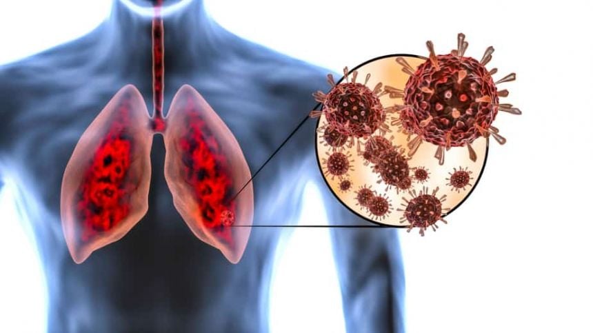 Drop in confirmed cases of COVID-19 in Galway hospitals following peak