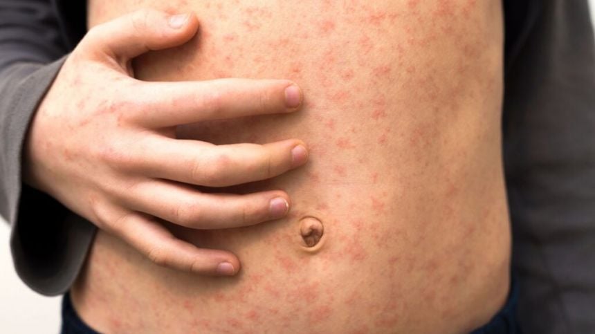 Second person in Ireland confirmed as having measles based in West