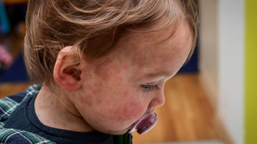 Galway TD calls for public information campaign on measles vaccine as uptake drops