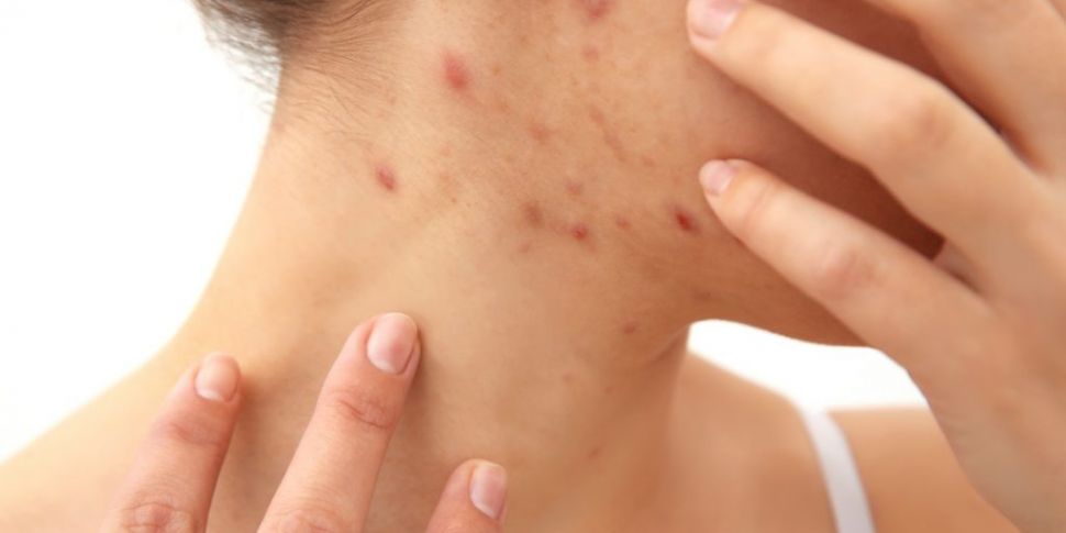 Teenagers with acne do better...