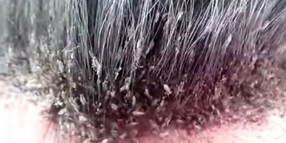 Head lice immune to over-the-c...