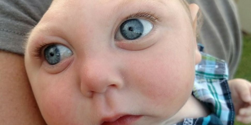 WATCH: Baby with rare brain di...