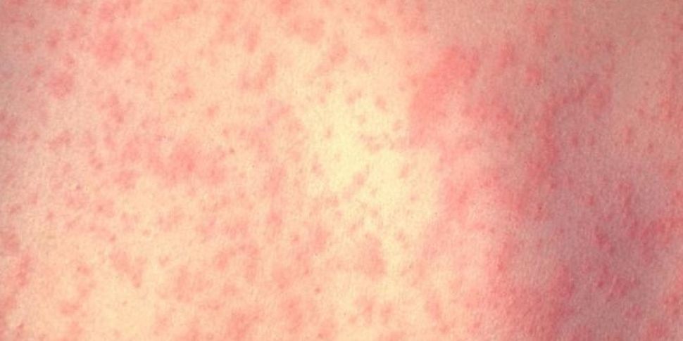 Measles outbreak confirmed in...