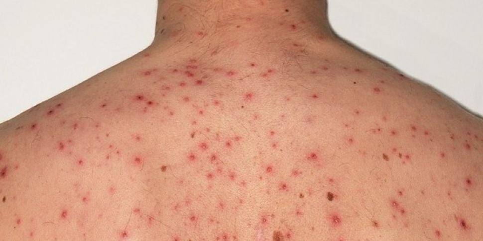 Dealing with adult acne 