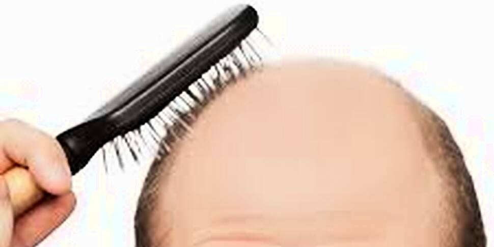 What can I do about my baldnes...