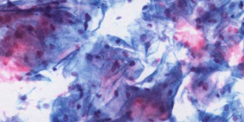Cervical cancer survivors hit...