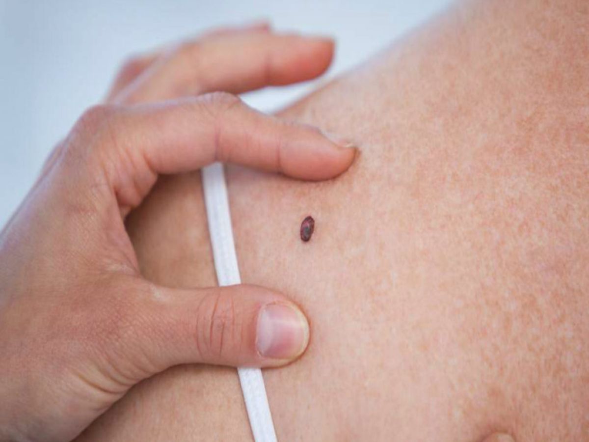 Skin Cancer The Warning Signs For Early Detection Newstalk