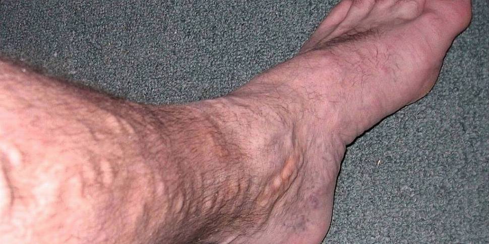 How to deal with varicose vein...