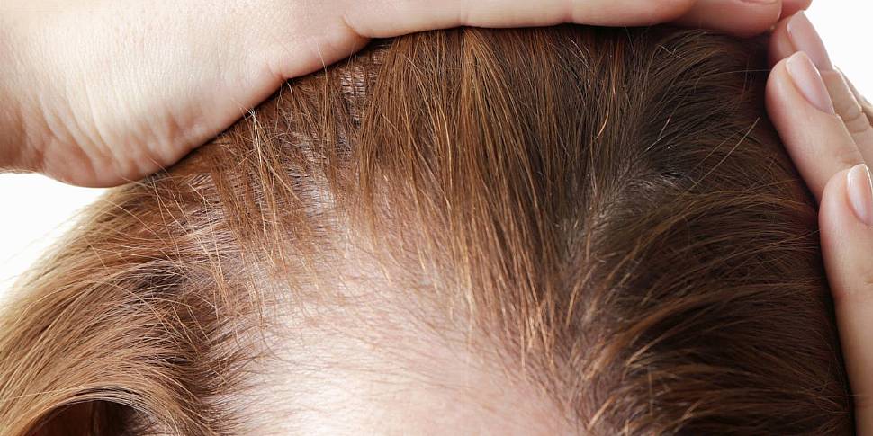 Increase in hair loss 'in wome...