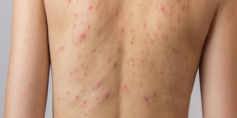 Dealing with adult acne