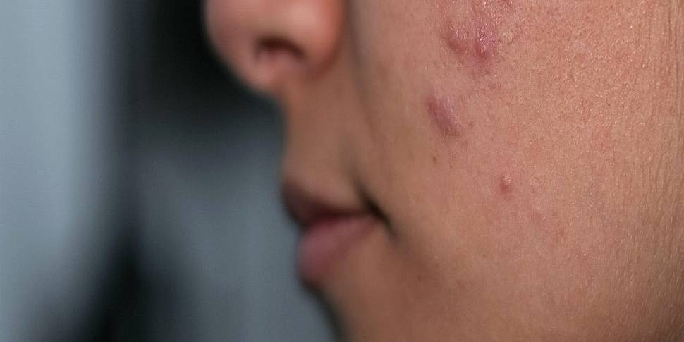 How to manage acne breakouts