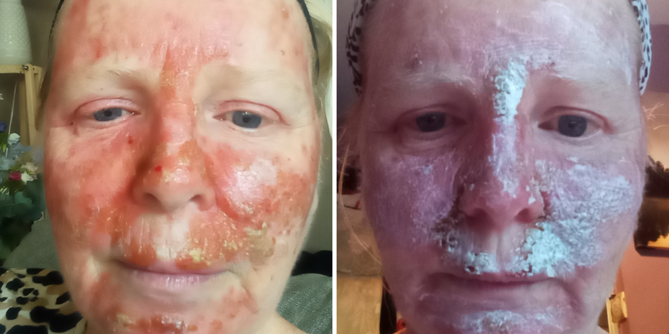 Woman with facial skin cancer...