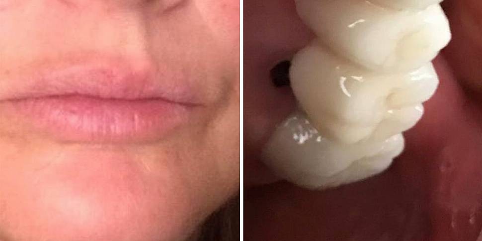 Woman to have ‘all teeth remov...