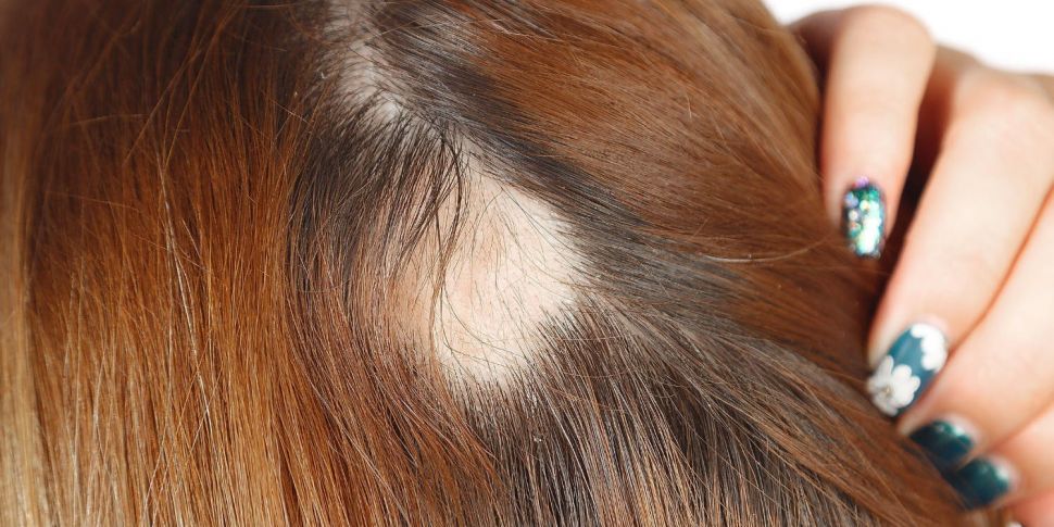 Coping with Alopecia