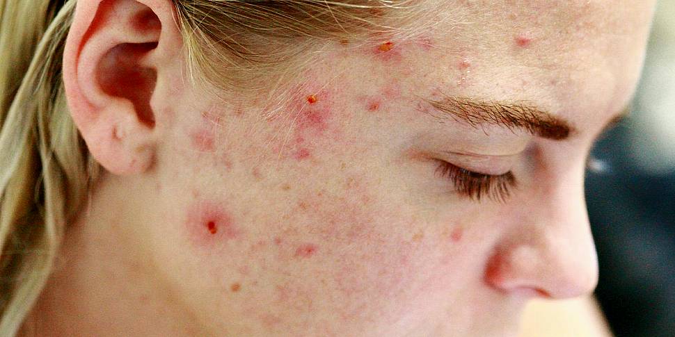 Kids Health Check: Acne