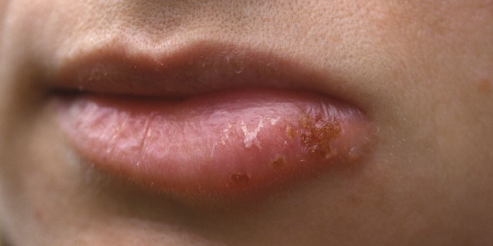 Expert calls for end to herpes...