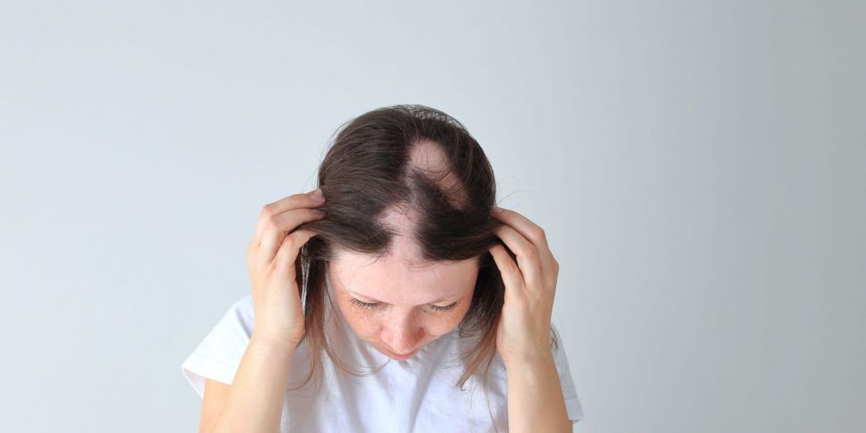 Alopecia: How one woman turned...