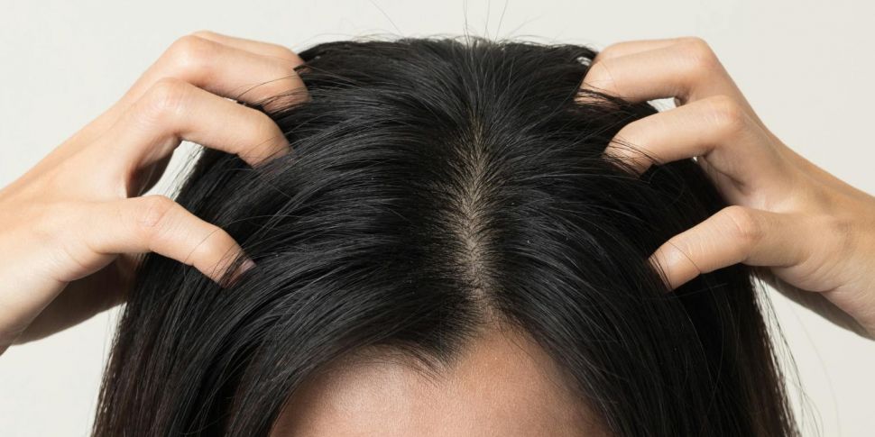 What are head lice exactly?