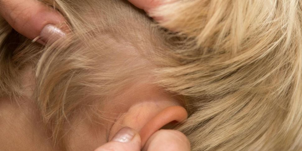 How to deal with an head lice...