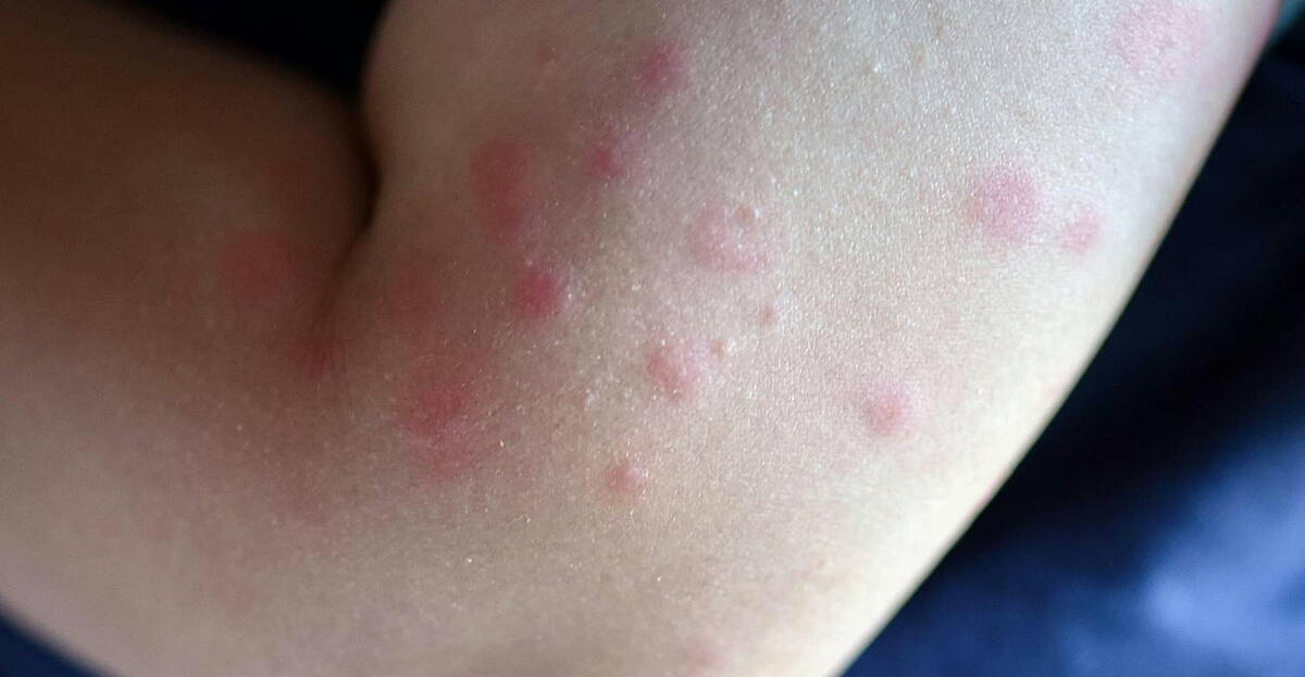 Nettle Rash Symbol What is Urticaria or better know as nettle rash? | Newstalk